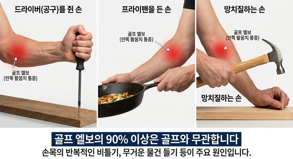골프 엘보의 여러가지 경우들